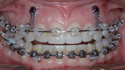 New Age orthodontics and orthopaedics with temporary anchorage devices