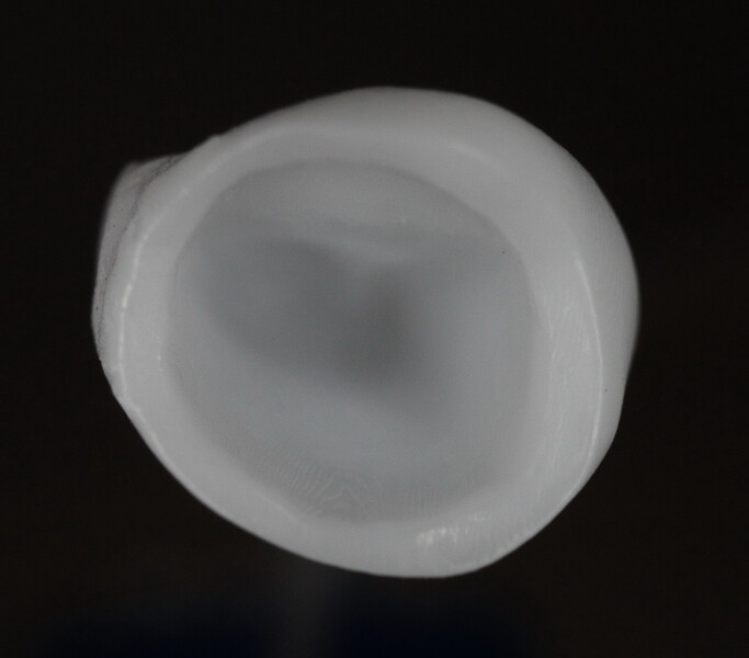 Fig. 11: 3D-printed crown for tooth #11, internal view.