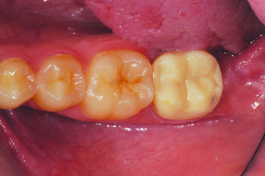 Fig. 1: Initial Situation with a molar tooth in need of endodontic treatment and subsequent crown placement.