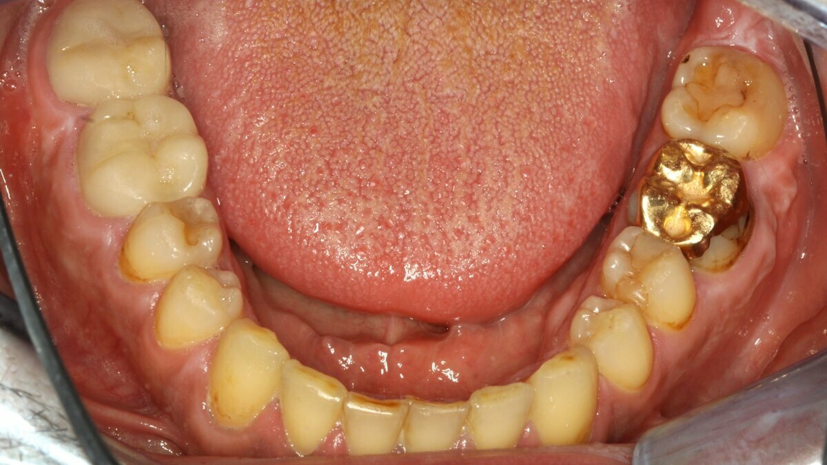 DT News Latin America Tratamiento de paciente con endocarditis y caries activas