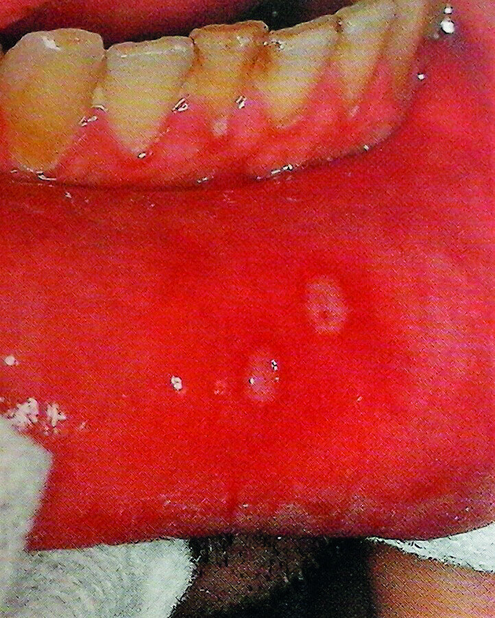 Aphtes de la lèvre inférieure (Spirglas H, Ben Slama L)