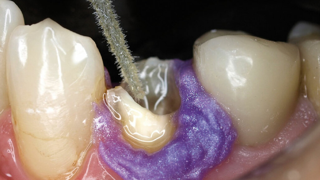 S čepem nebo bez čepu – otázka míry destrukce zubních tkání