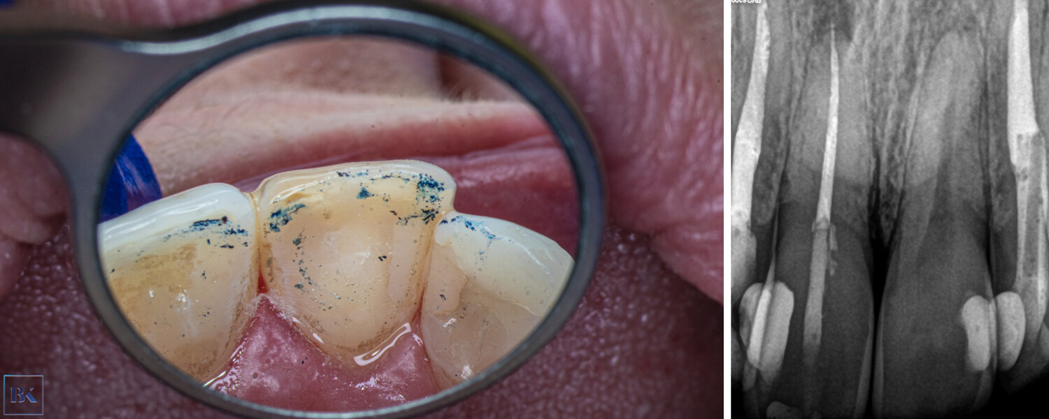 Figs. 11a & b: Occlusal check (a) and the control radiograph of the composite seal (b).