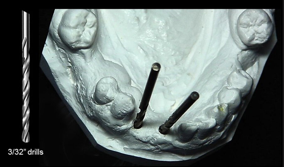 Fig. 2: A 3/32 in. drill was used to make a pilot hole in the edentulous area of the cast where implants were planned and guide posts inserted.