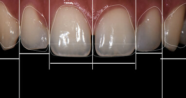 Diastema closure using a direct two-matrix technique