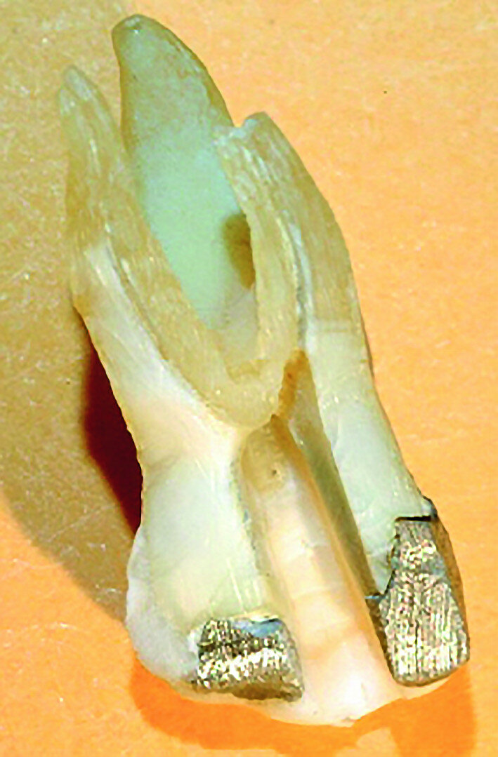 Fig. 3 : Préparation sagittale d’une molaire supérieure avec cavité d’accès inclinée en direction mésiale, parallèle à la face mésiale de la dent et à courte distance de la moitié distale de la dent.