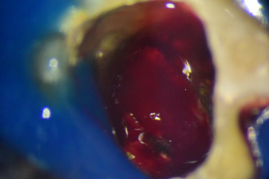 Fig. 3: Intra-op image of tooth #46 captured under the dental operating microscope at 16× magnification.