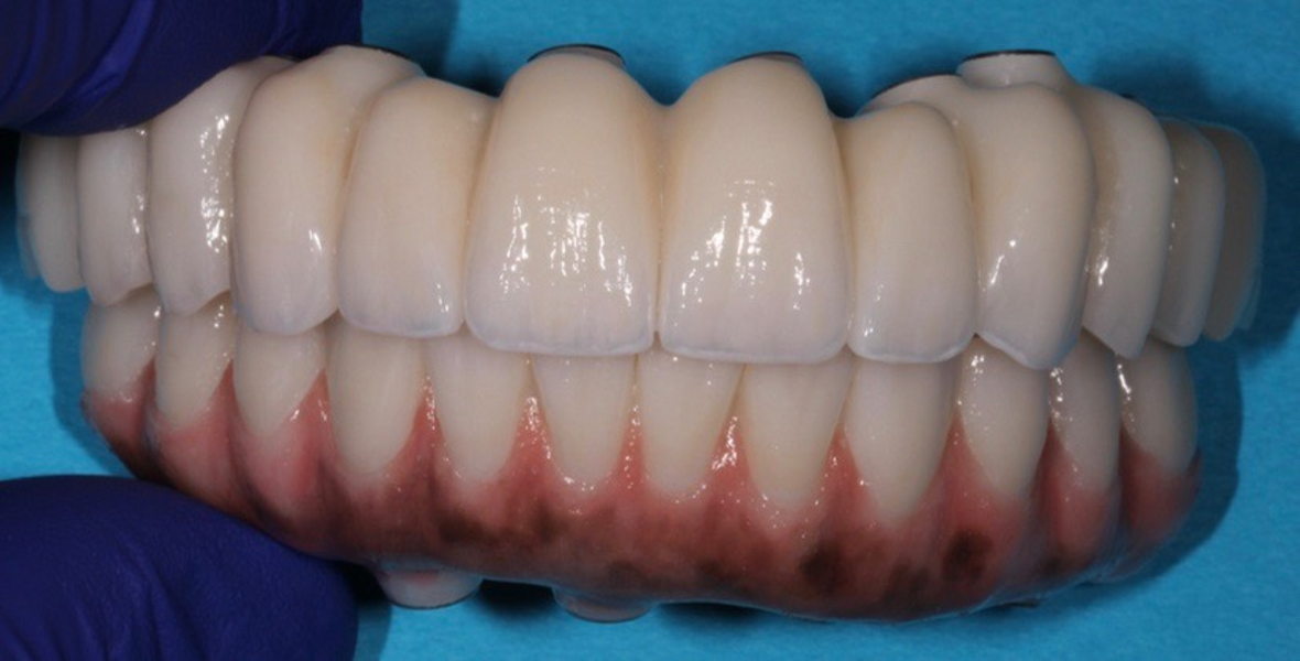 Fig. 26: ArgenZ HT+ Multilayer final prostheses with characterised gingiva.