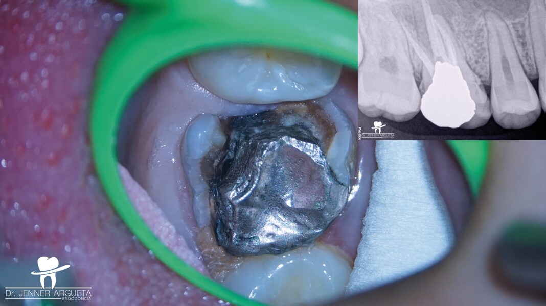 Fig. 1 : Première molaire maxillaire fortement endommagée, restaurée avec un ancien amalgame après un traitement endocanalaire, et présentant des caries récurrentes