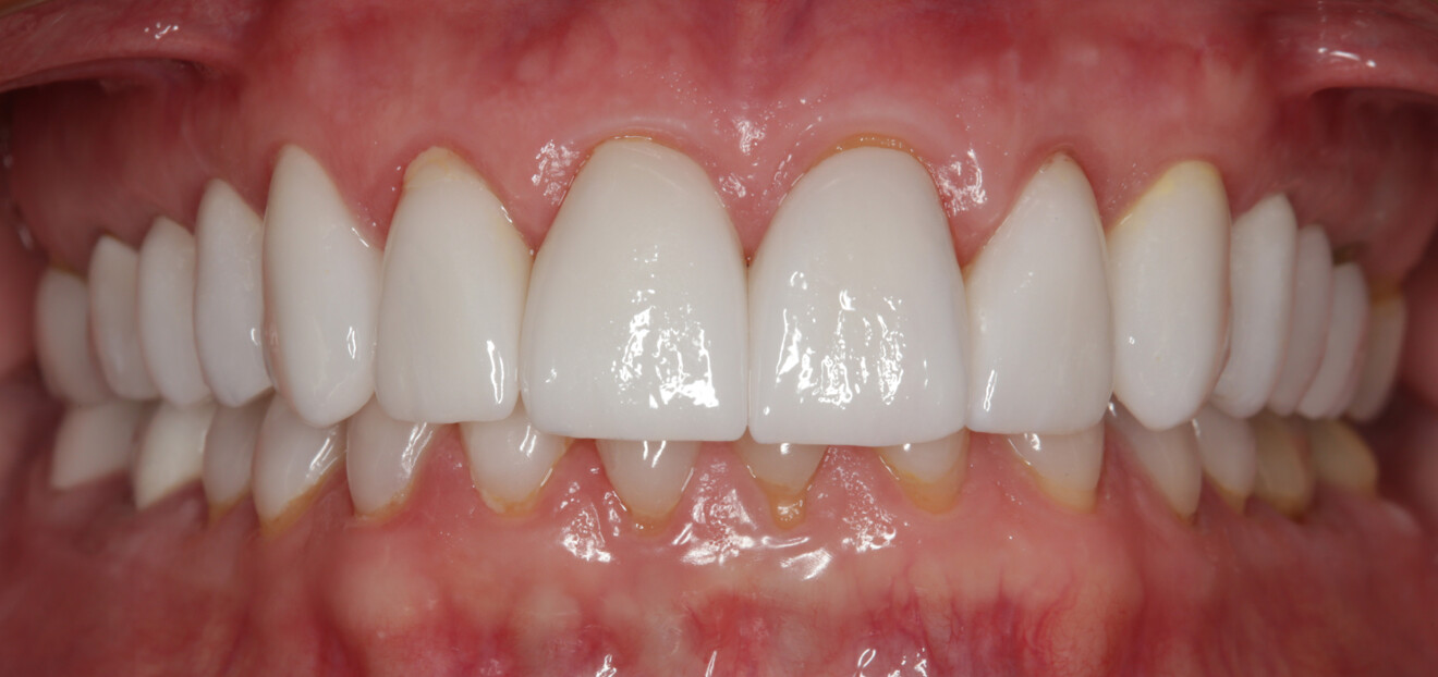Fig. 21: One-week post-op retracted view of the definitive restorations after cementation.