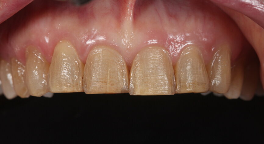 Fig. 19: Intra-oral photograph of conservative veneer preparations.