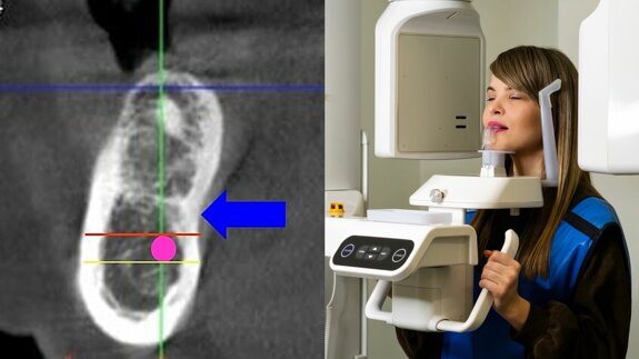 Risk of lingual concavity in implantology: CBCT correlates with inferior alveolar nerve canal