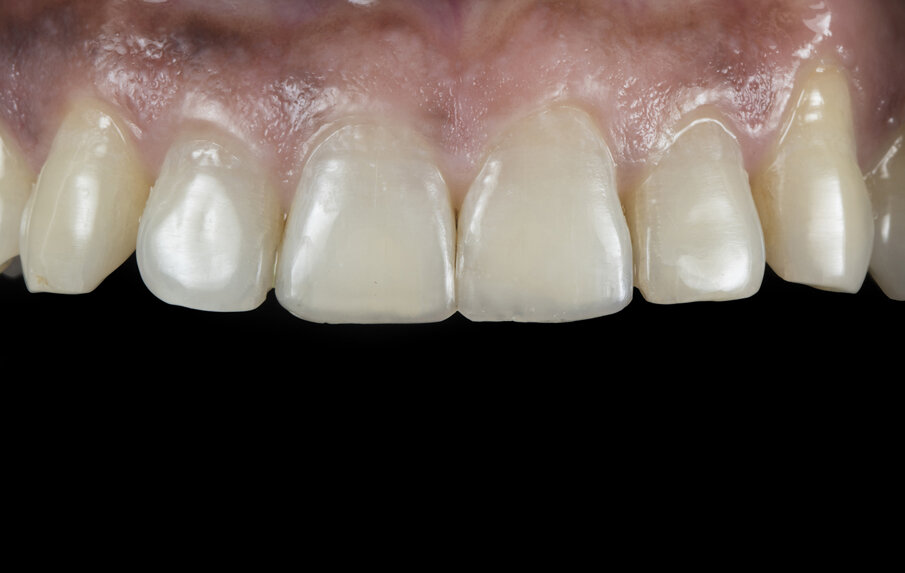Fig. 14: Intra oral image showing final restoration