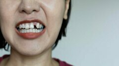 Une étude révèle qu'un mauvais contrôle de la glycémie entraîne la perte de dents à un âge moyen