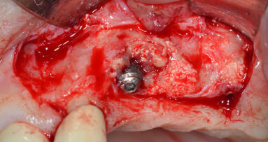 Decontaminazione implantare mediante dispositivo a cavitazione ultrasonica