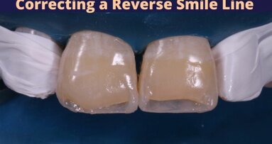 Correction of a Reverse Smile Line – Turning back the clock!