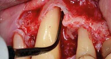 Rigenerazione tissutale guidata (GTR) in difetti parodontali profondi