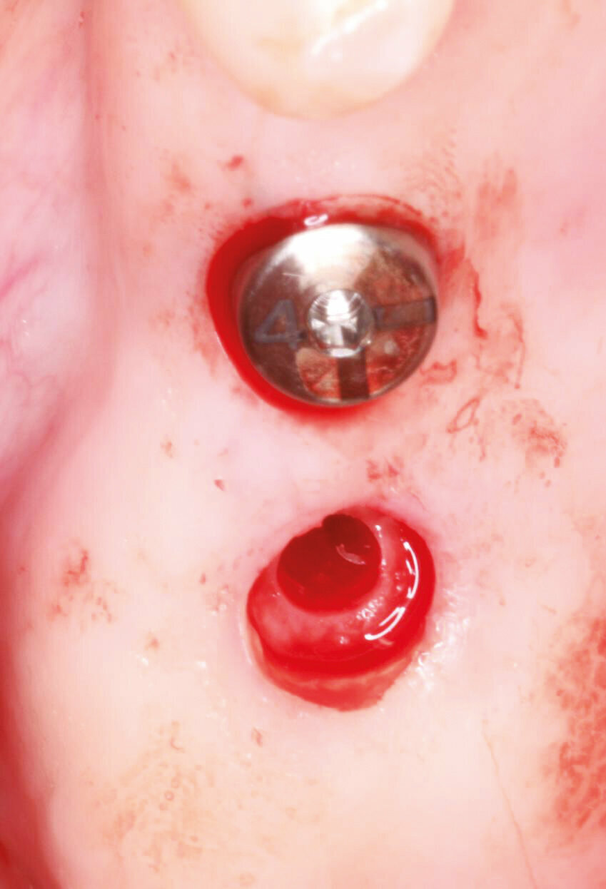 Fig.11: Second implant site prepared and tissue removed for flapless approach. 
