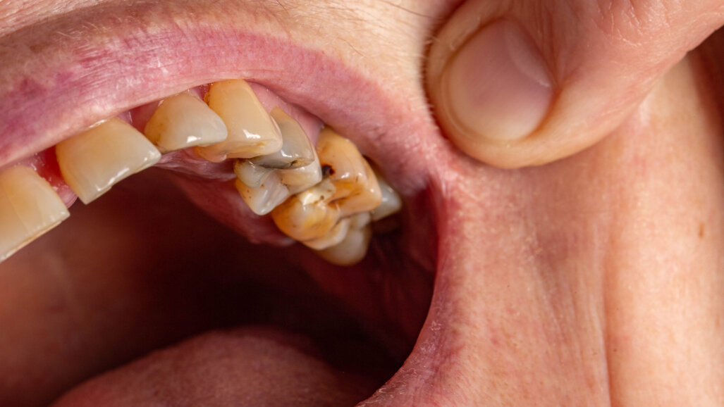 New guide offers refresher on caries treatment and pulp capping