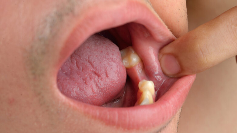 Saúde bucal deficitária pode indicar risco de diabetes