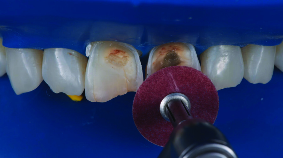 INITIAL SITUATION: Preoperative frontal view of the patient’s teeth, showing severe erosive tooth wear on the vestibular surfaces and incisal edges.