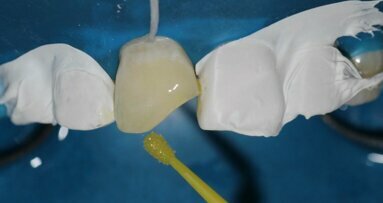 Developing tight proximal contacts in anterior teeth using Unica Anterior matrix – A case report