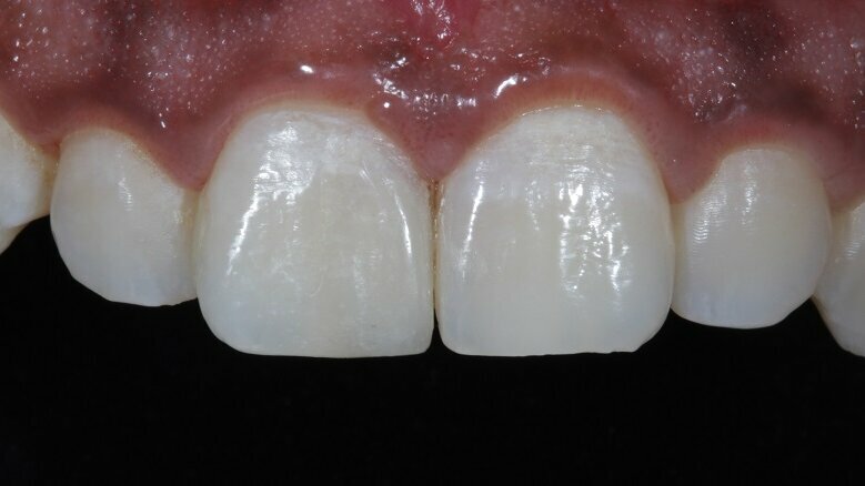 maxillary central incisor
