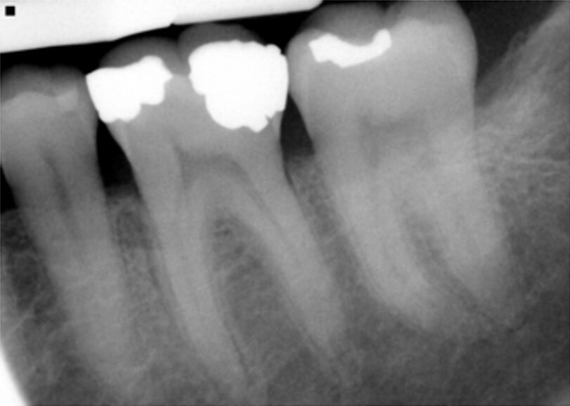 Fig. 16: Patient presented with percussion and hot sensitivity on the lower first molar that she reported was increasing over the past week. 