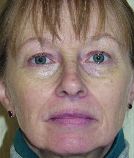 Prétraitement facial, post-traitement facial six mois et neuf mois après, et enfin, évaluation morphométrique du changement.