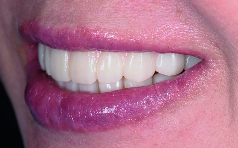 Fig 27. Post-operative smile with provisional profile prosthesis