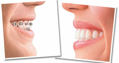 Υποτροπή του συνωστισμού των κάτω προσθίων δοντιών μετά την ορθοδοντική θεραπεία