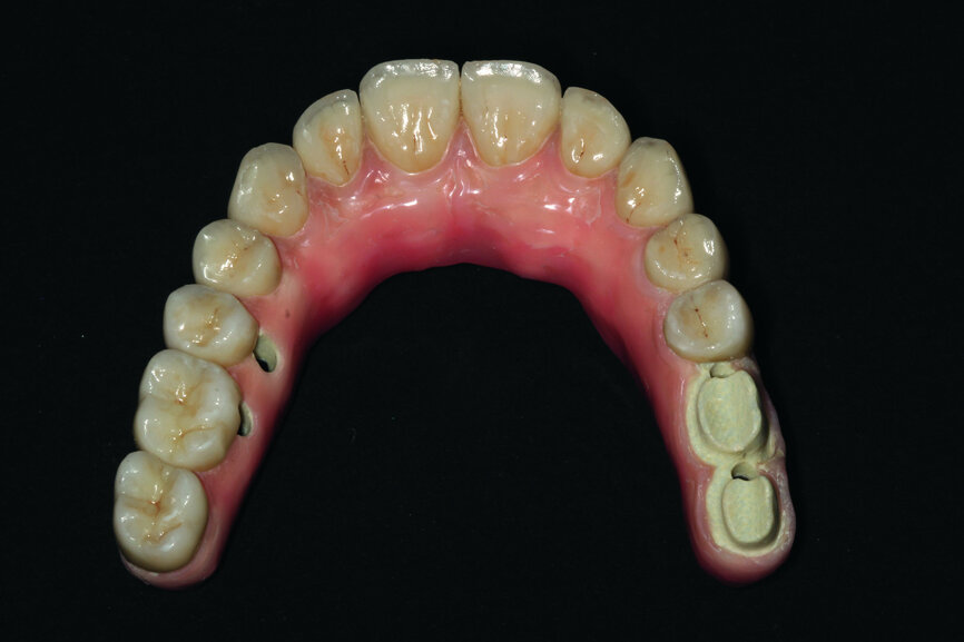 Fig. 23: Final restoration prior to handover and the placing of crowns.