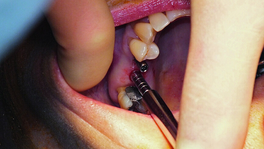 Fig. 13: Sinus lift osteotome in place.
