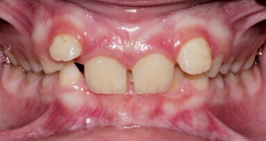 Výhody použití Invisalign First alignerů pro první fázi ortodontické terapie