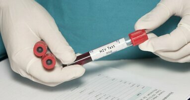 Parodontale behandeling extra belangrijk bij hiv-patiënten
