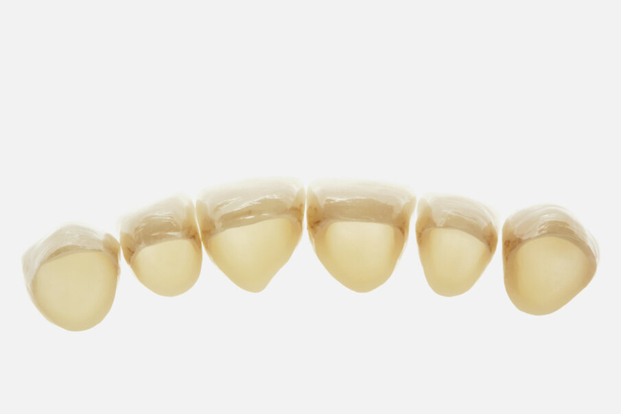 Fig. 18: The
nature-like translucency of Zolid FX makes it possible to dispense with part
of the dentine layering with veneering ceramics.