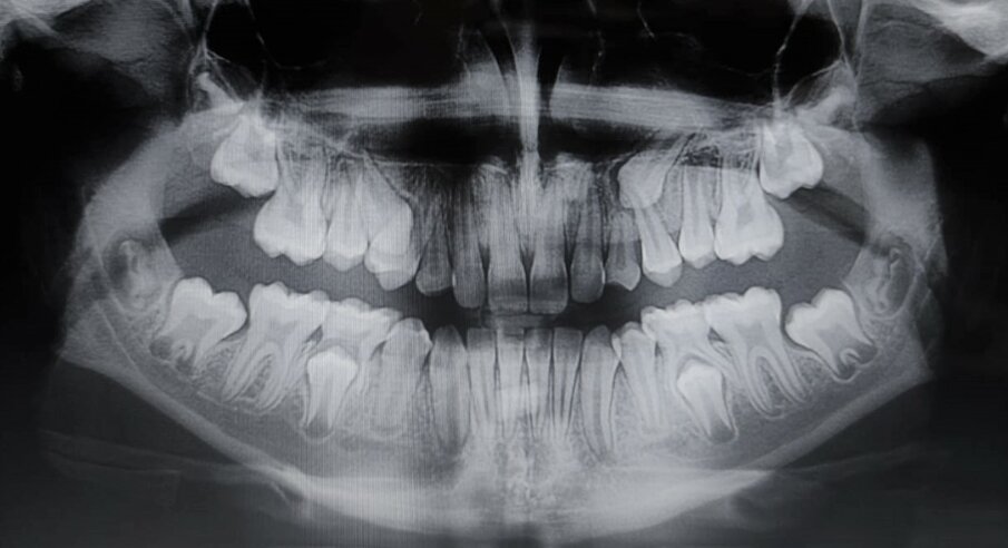 Figg. 2a, 2b: Rx-OPT iniziale di una paziente di anni dieci con trasposizione caninopremolare 1.3-1.4 e ritenzione canina dell’elemento 23(A); Rx-OPT in corso di trattamento della stessa paziente, in cui è mostrata la risoluzione ortodontica con mantenimento dei denti trasposti nel primo quadrante (B).
