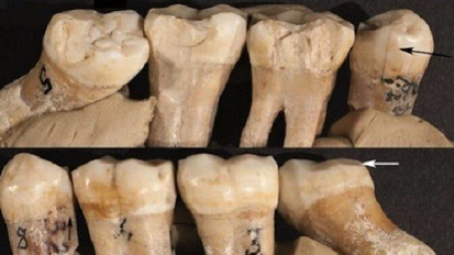 Hallan signos de odontología prehistórica en el Hombre de Neandertal