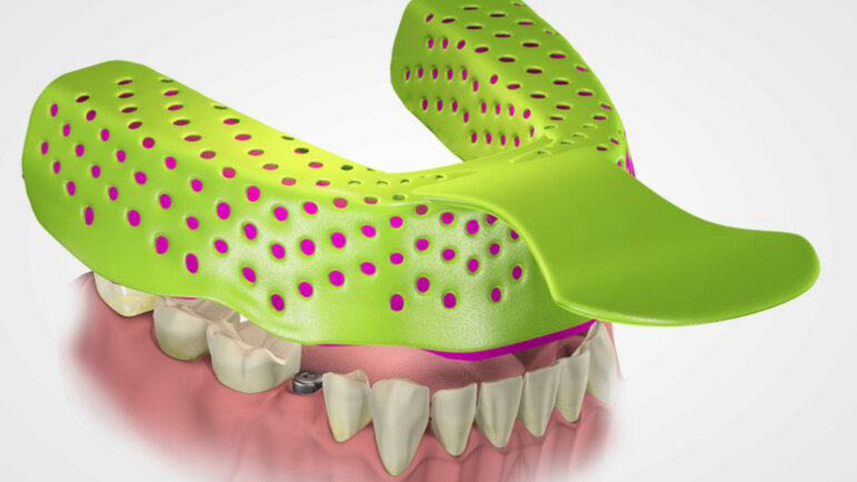 Study compares accuracy of open and closed dental implant impression ...