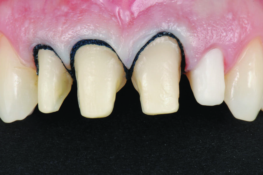 Fig. 3: The placement of two retraction cords per tooth to open up sulcus well for impression taking.