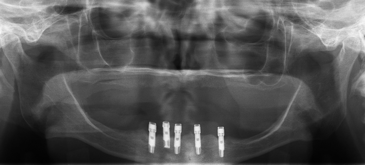 Fig. 1: Pre-treatment radiograph showing five implants clustered in the anterior mandible.
