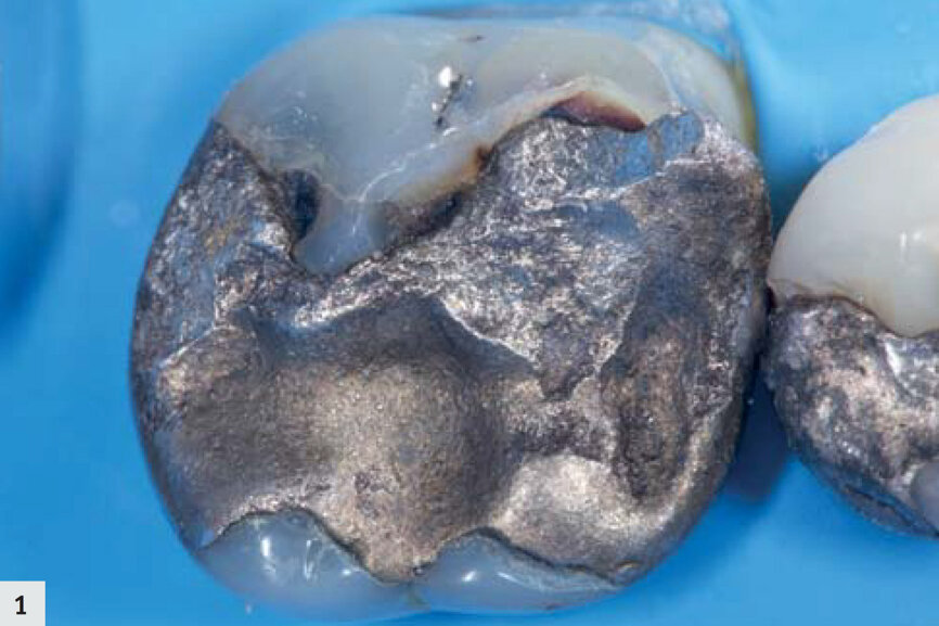 Fig. 1 : Molaire avec une ancienne restauration à l’amalgame défectueuse. 