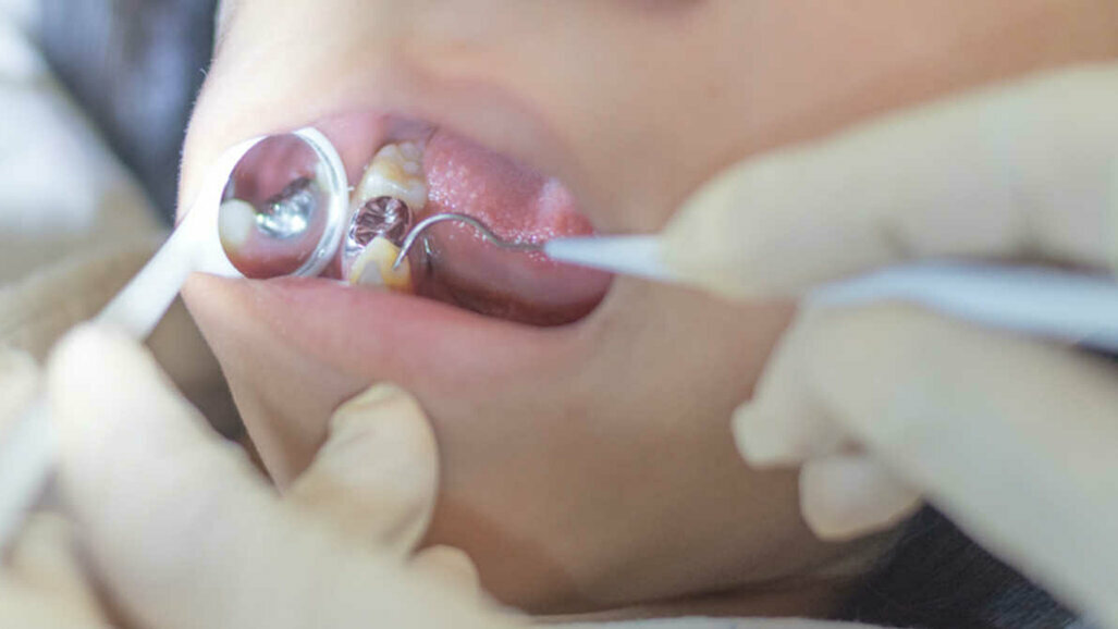 Les particules de mercure  : source importante d'exposition  dans la profession dentaire