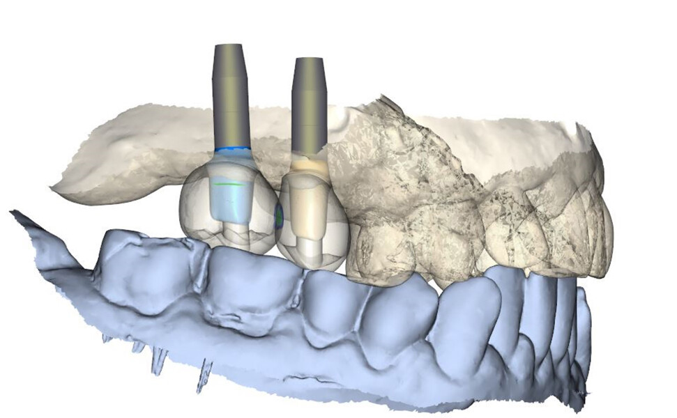 Fig. 14: Design of Atlantis abutments and zirconia crowns.