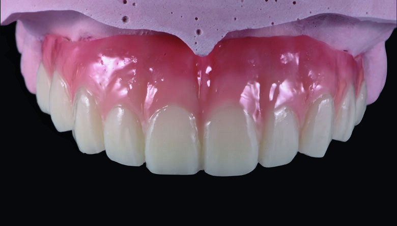 Fig 17. Ceramage Flowable GUM Red (F-GUM-R) and White (F-W) were painted to mimic the mucogingival junction and vascular alveolar 