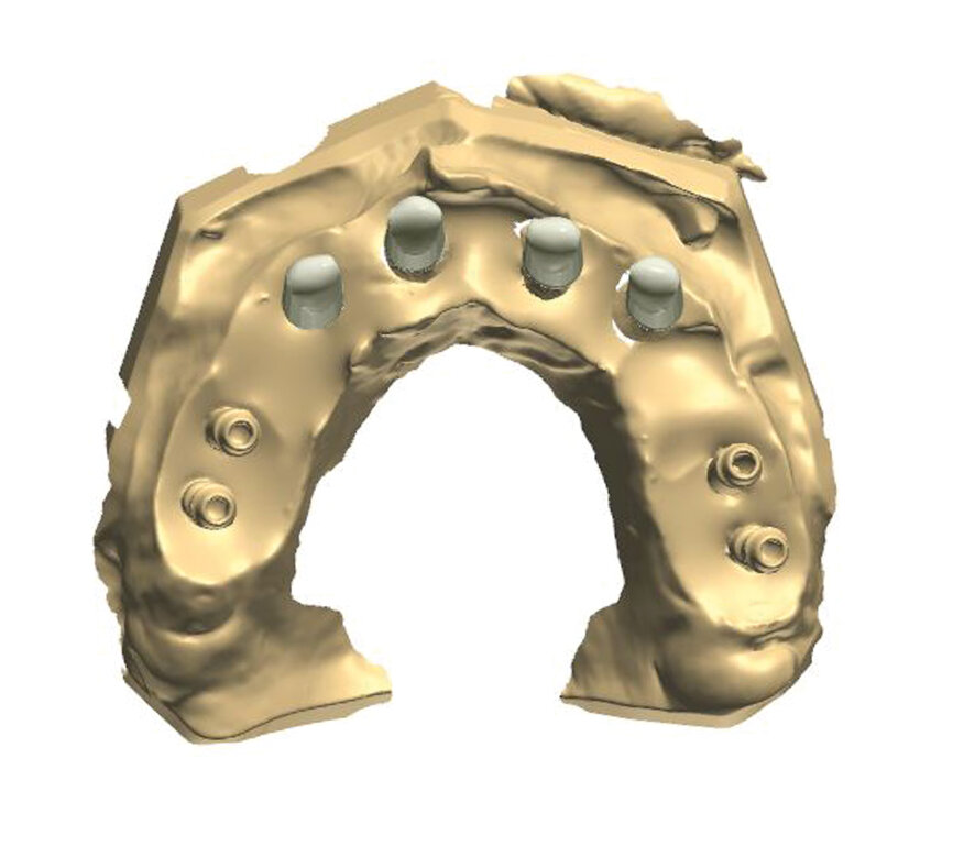 Fig. 6: Design of the telescopic crowns placed onto the abutments at the frontal section.