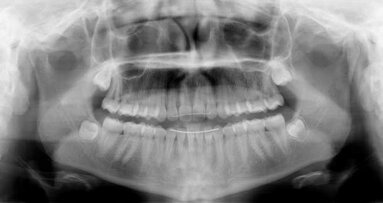 Optimal timing for management of impacted canines
