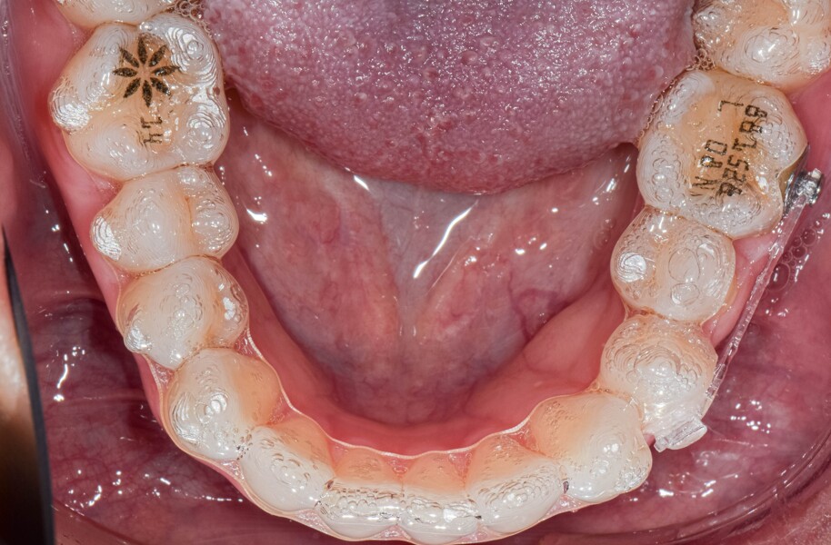 Fig. 11: Invisalign aligners with a metal Precision Aligner Button bonded to the mandibular left first molar and a clear Precision Aligner Button to the rotated premolar. A clear elastic power chain connected the two teeth and was changed every four weeks.