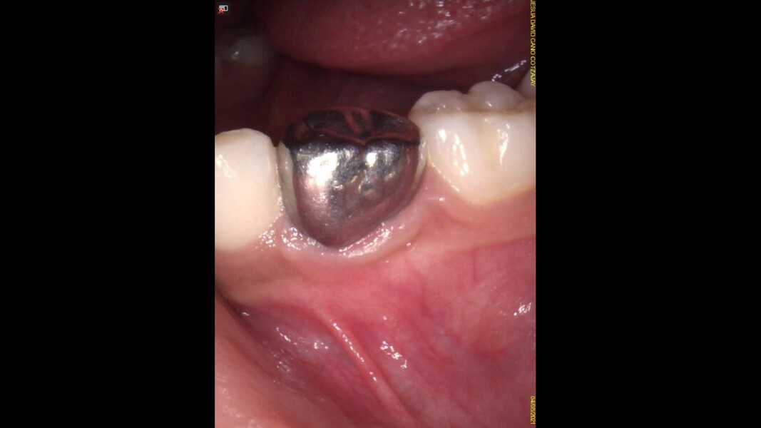 Fig. 13: Clinical aspect at final evaluation showing healthy gingival tissue.