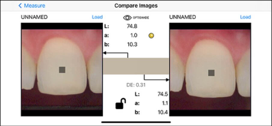 Fig. 11c: Same tooth, same surface (clean), *different time frame, same positioning, *different device, same background. Shade difference: 0.31. Reliable measurement. The asterisks indicate the parameters critical to the reliability of the measurement.